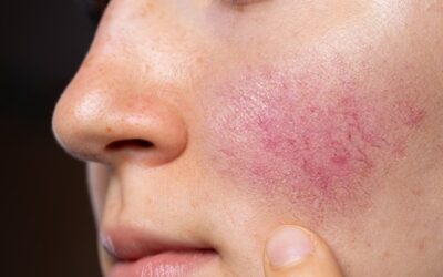 Rosacea: consigli dermatologici per controllare rossore e irritazioni