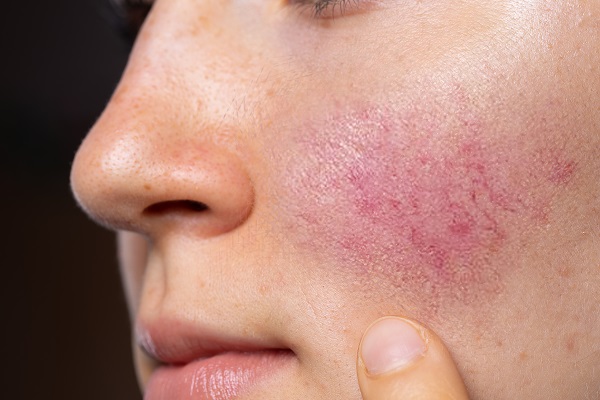 Il rossore tipico della rosacea.